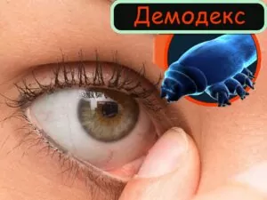 демодекс глаз